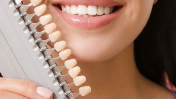 The Different Types of Veneers A Guide to Finding the Right Fit for Your Smile