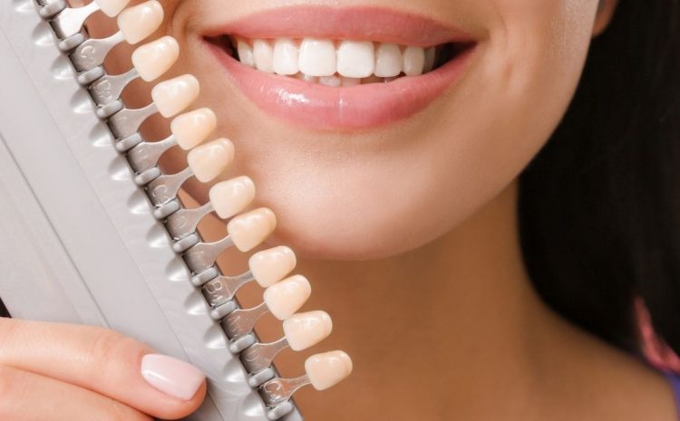 The Different Types of Veneers A Guide to Finding the Right Fit for Your Smile